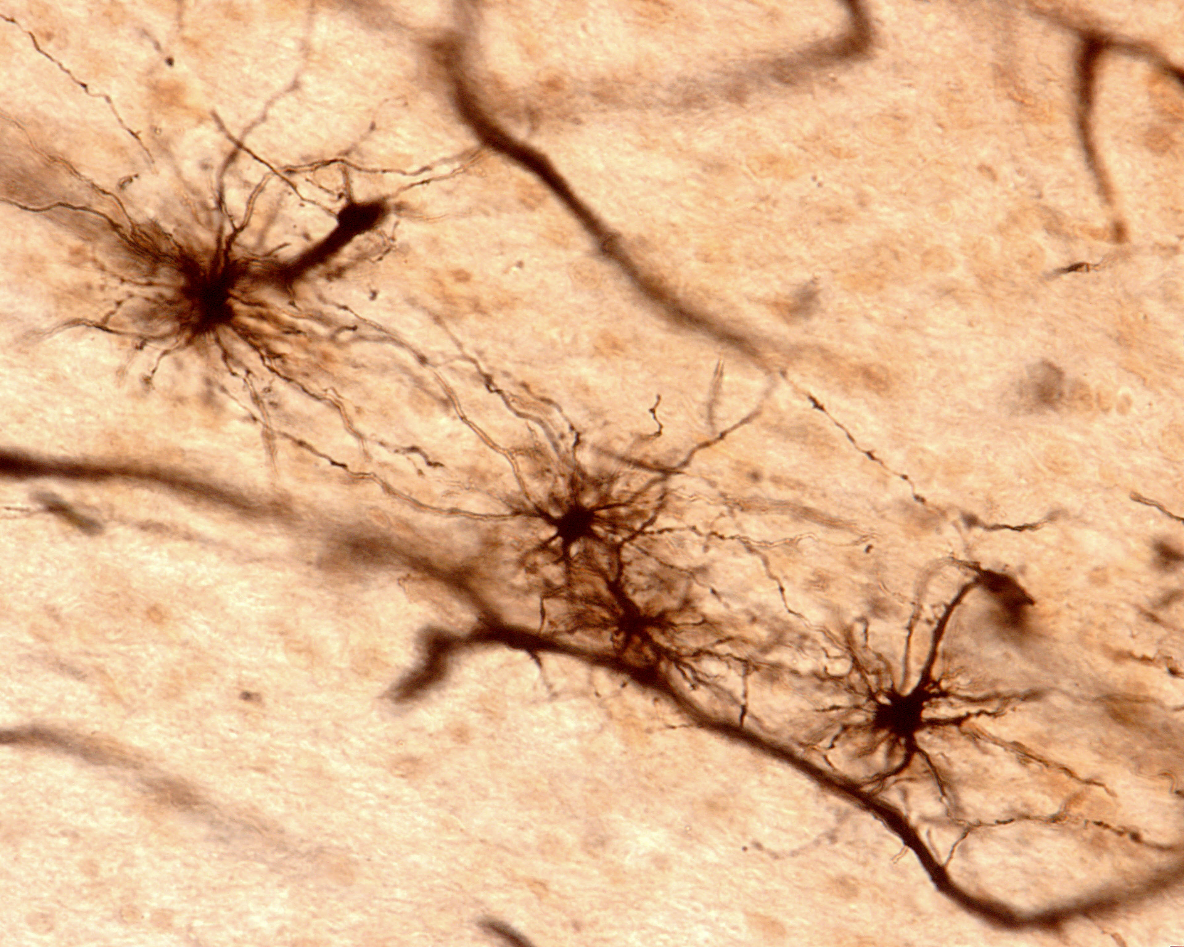 Frataxin deficiency in astrocytes likely contribute to Friedreich's ataxia pathology