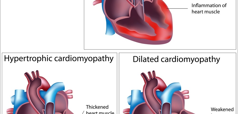 Deferiprone Effective At Treating Friedreich's Ataxia-Induced Cardiac ...