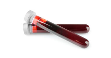 FA biomarkers, neurofilament