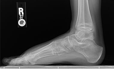 X-ray image of patient's foot deformity
