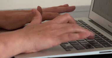 Patient typing showing mild hand deformity