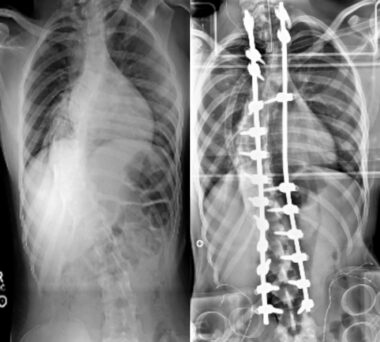 Patient pre- and post-surgery for scoliosis
