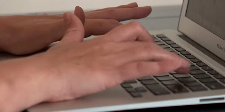 Hand deformity in Friedreich's ataxia